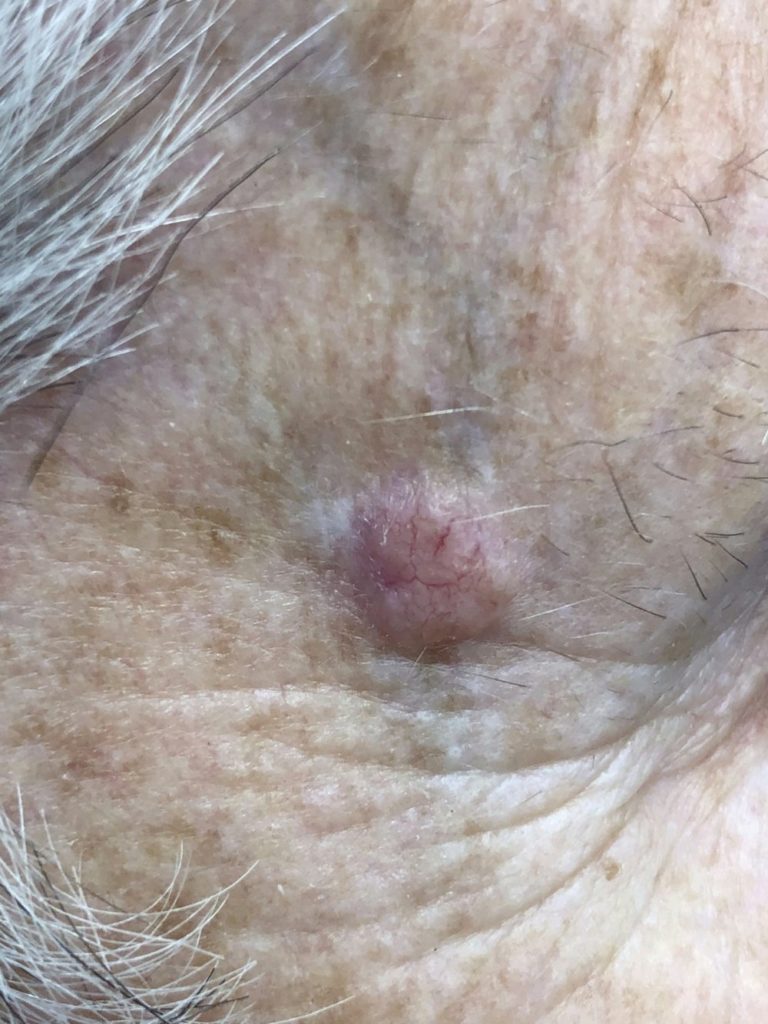 bcc skin cancer example