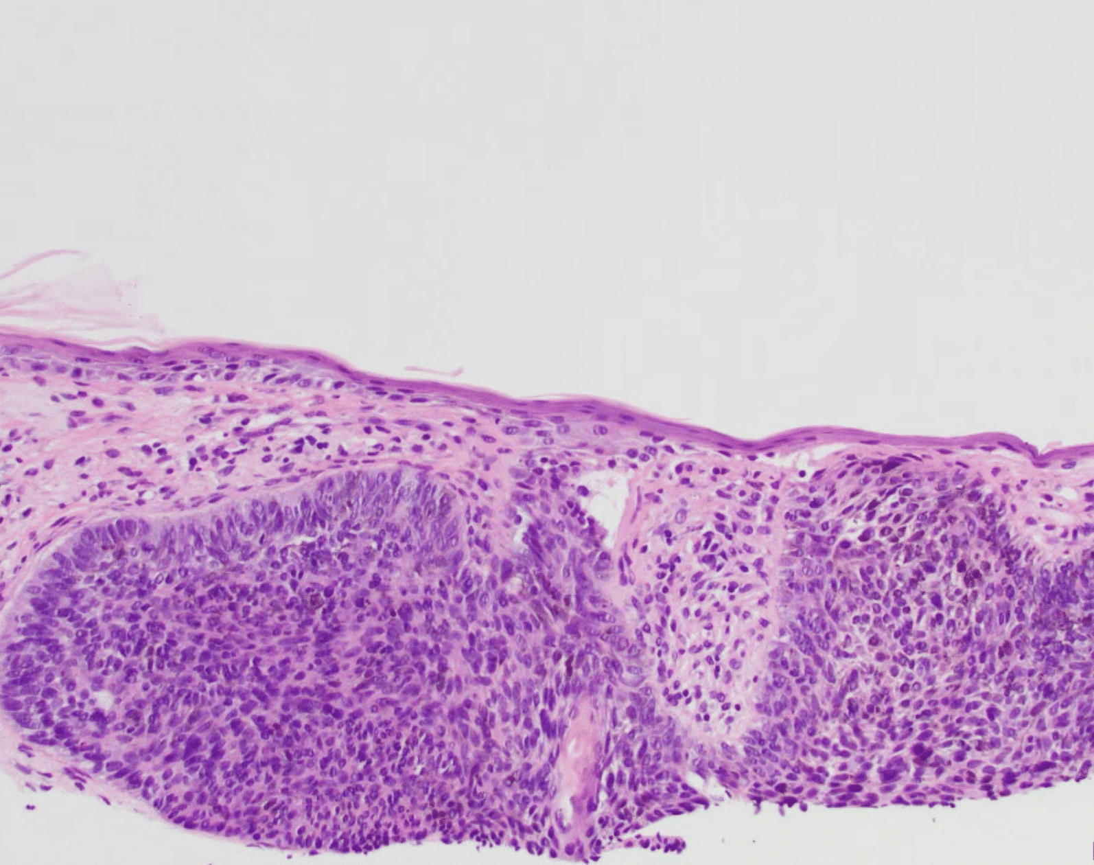 basal cell skin cancer pathology