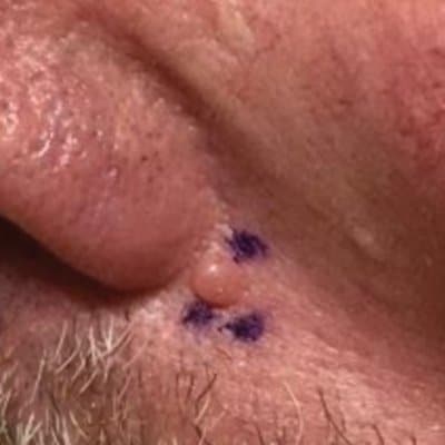 bcc skin cancer example