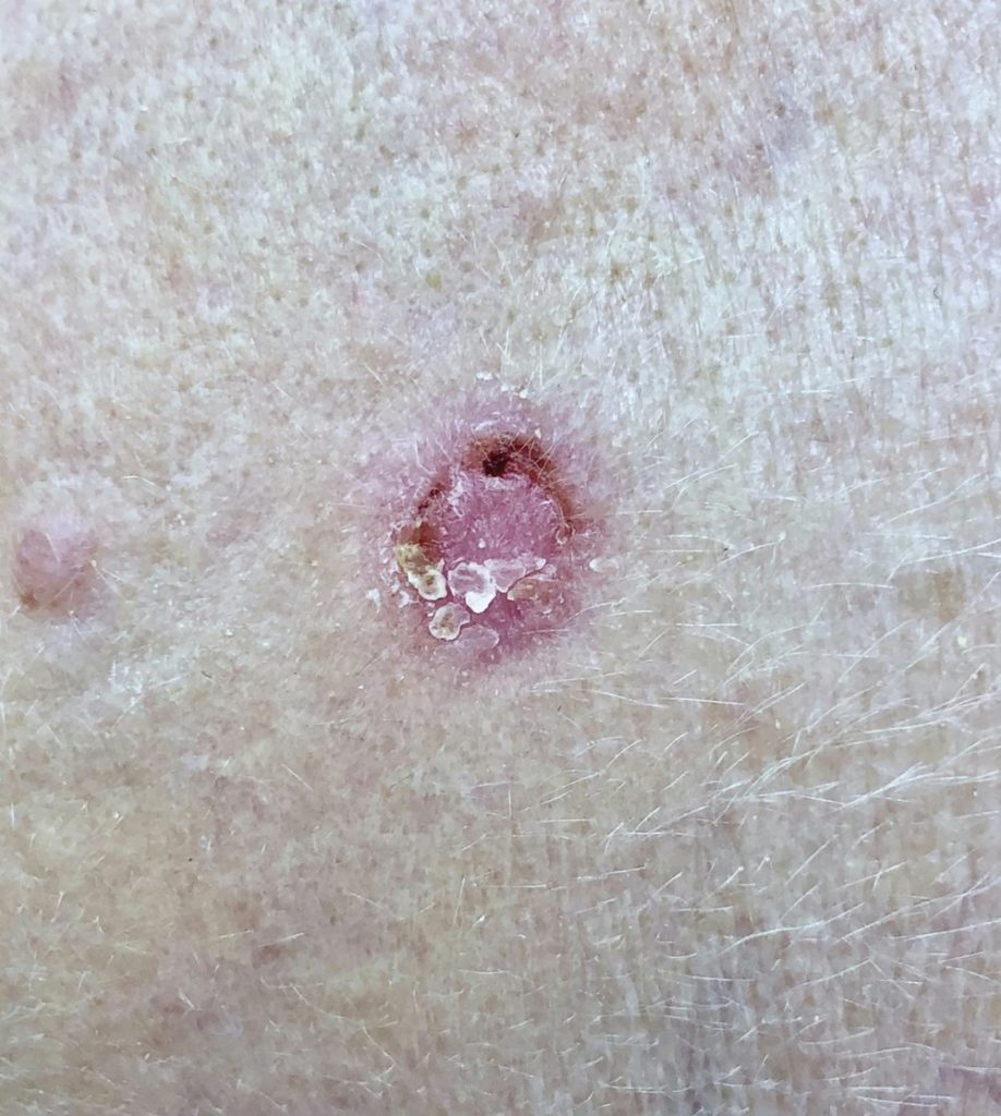 scc skin cancer examples