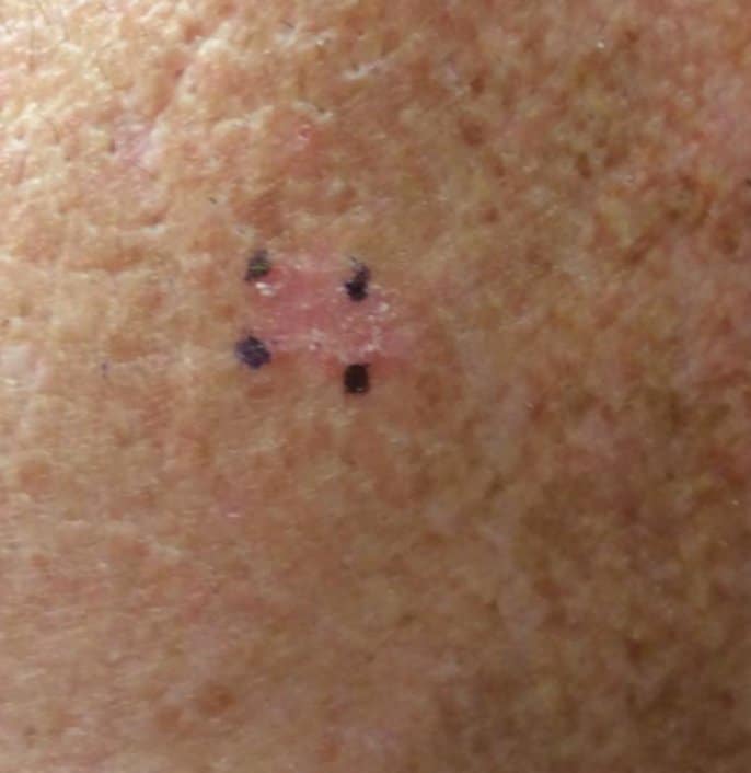scc skin cancer example