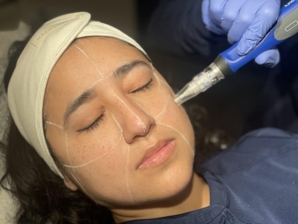 microneedling with a dermatologist