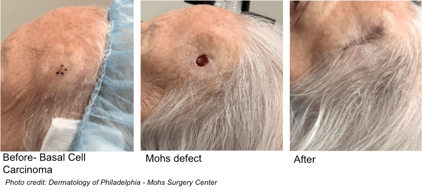 mohs surgery mohs defect
