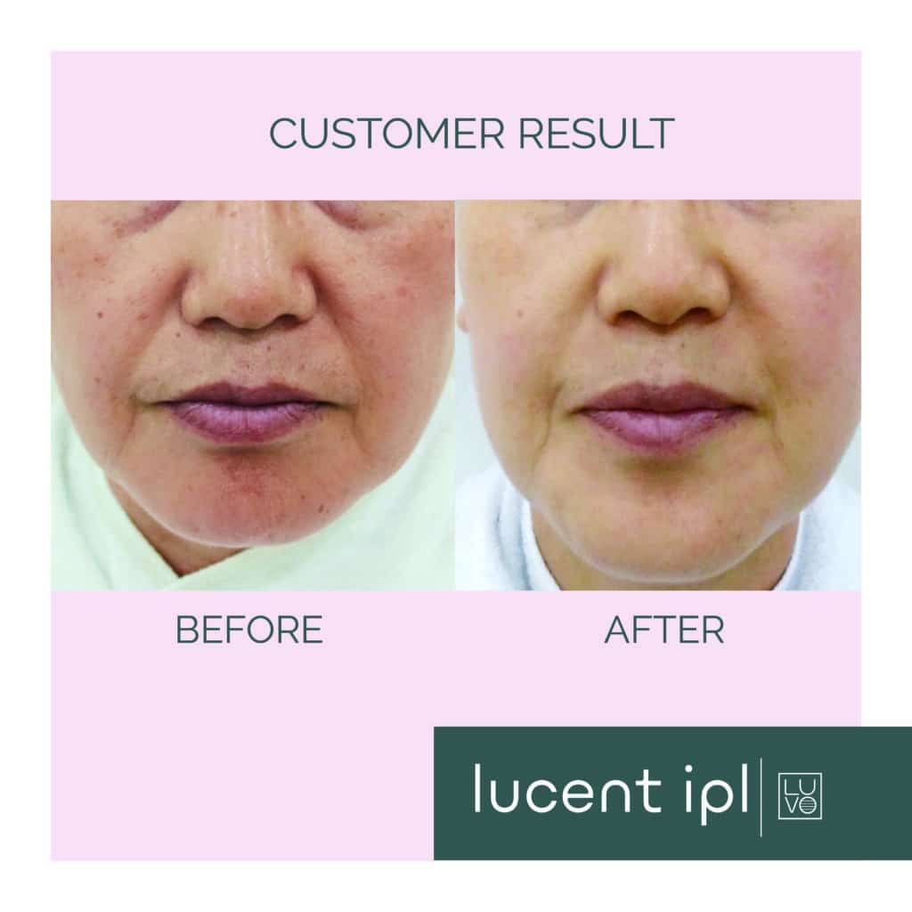 IPL Photofacial before and after results