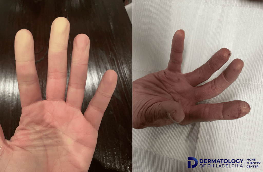 Raynaud's Disease in Fingers